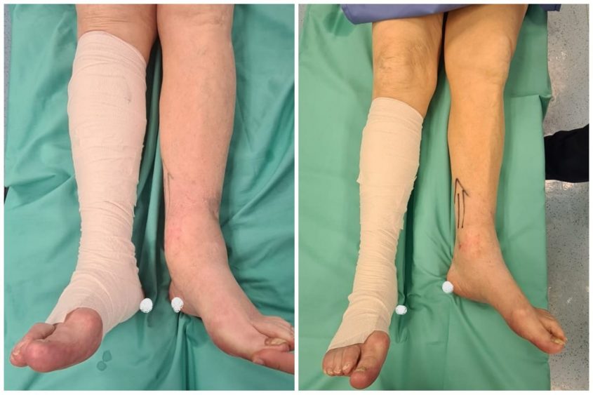 הרגליים לפני ואחרי הניתוח